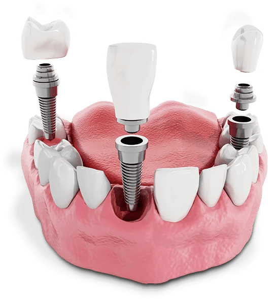 Explore the cost of dental implants in Charlottesville (we're the lowest). 100% Transparent Pricing – 0% Financing Available. FREE Consultations!