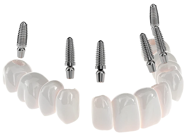 3-On-6 Dental Implants are the ideal solution to replace a full arch of failing or missing teeth • Only 3-On-6 provider in Virginia • FREE Consultations!