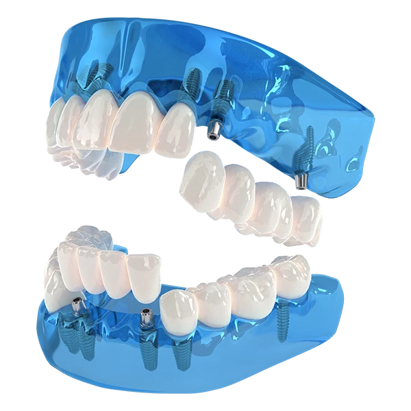 3-On-6 Dental Implants are the ideal solution to replace a full arch of failing or missing teeth • Only 3-On-6 provider in Virginia • FREE Consultations!