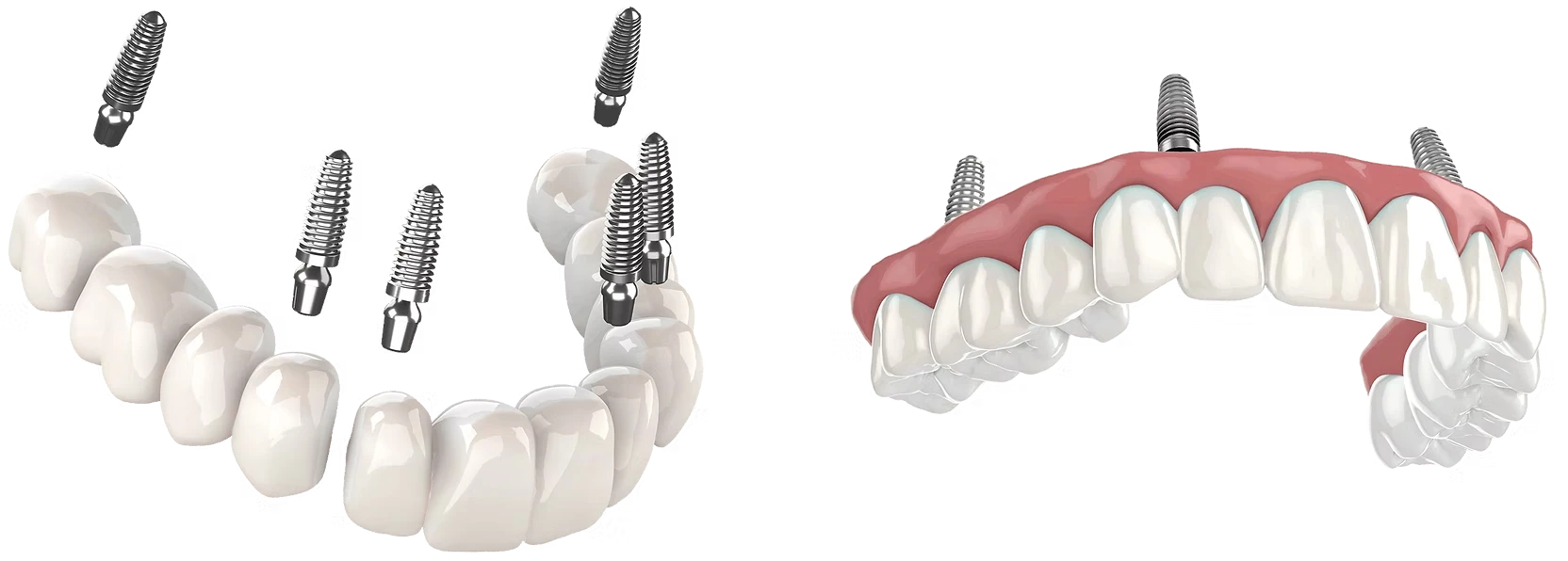 The best dental implants in Charlottesville, VA • 5,000+ Implants Placed • 280+ 5 Star Reviews • 20% Less • FREE Consultations!